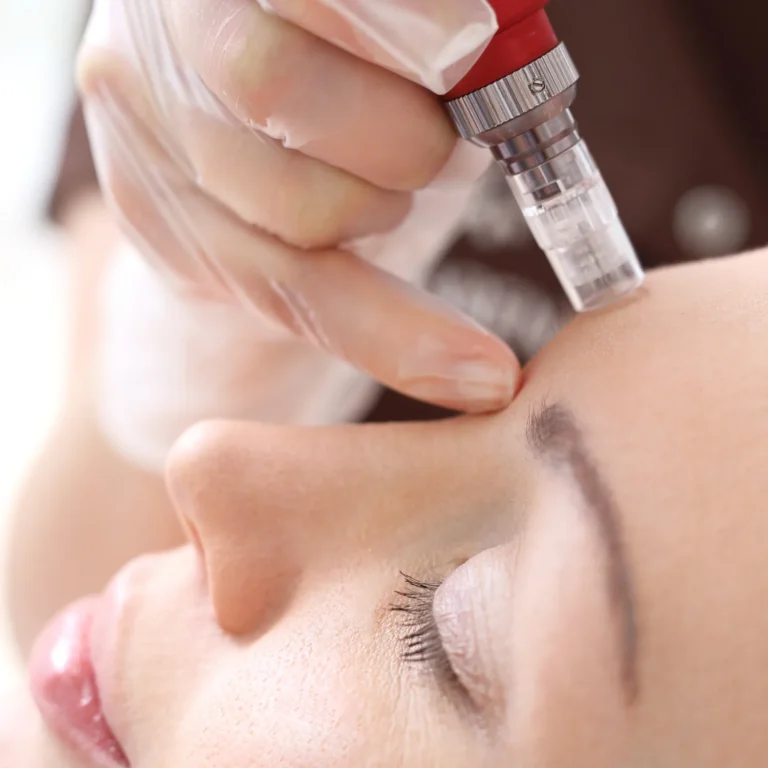 Mezoterapie cu inductie de colagen