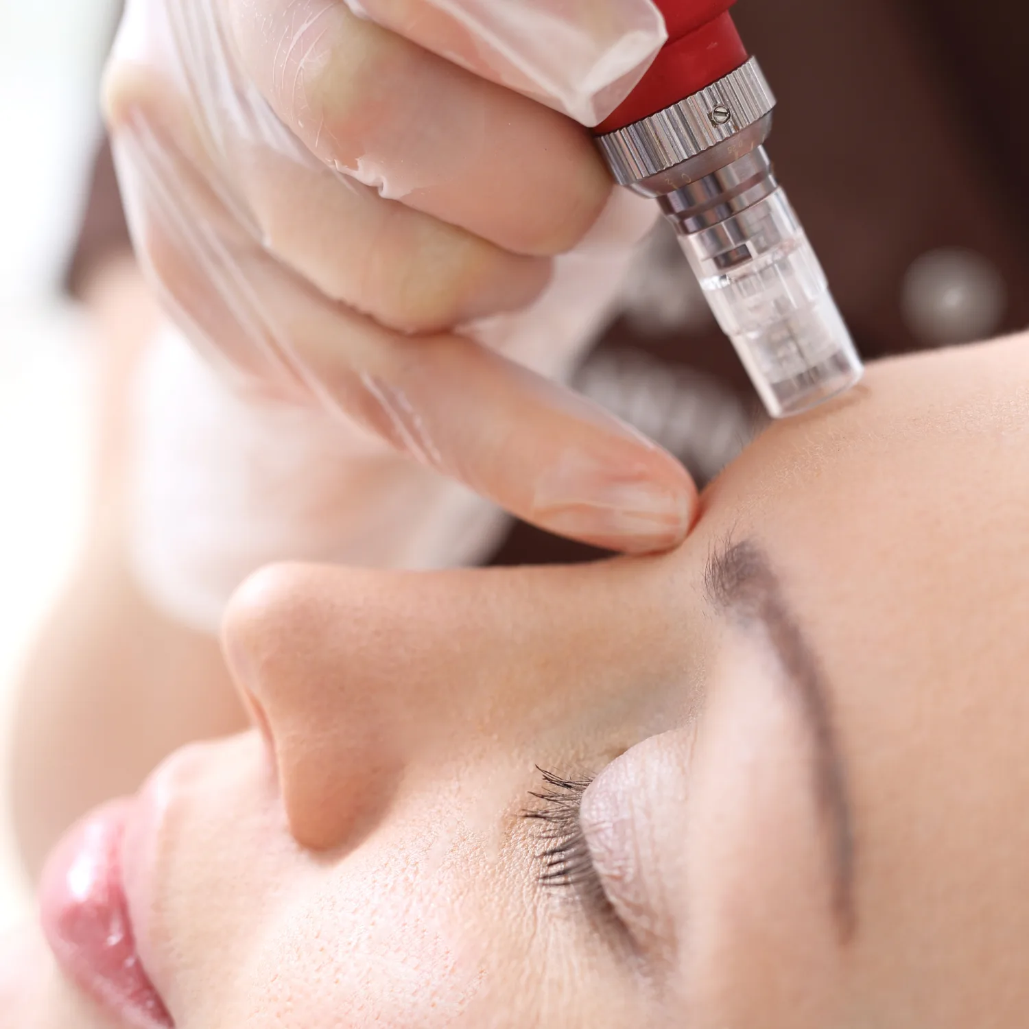 Mezoterapie cu inductie de colagen
