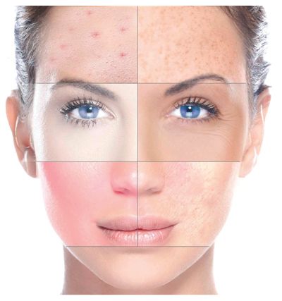 Microneedling – un super-erou al pielii